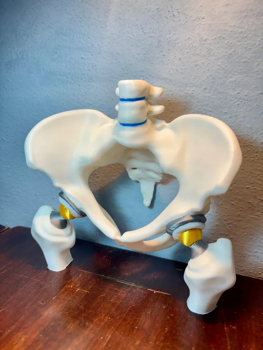 Prótesis de cadera bilateral, vista 2